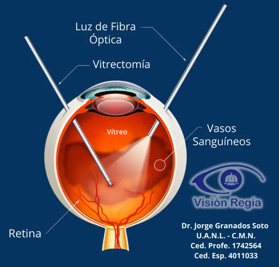 Facovitrectomia-Mty (2)