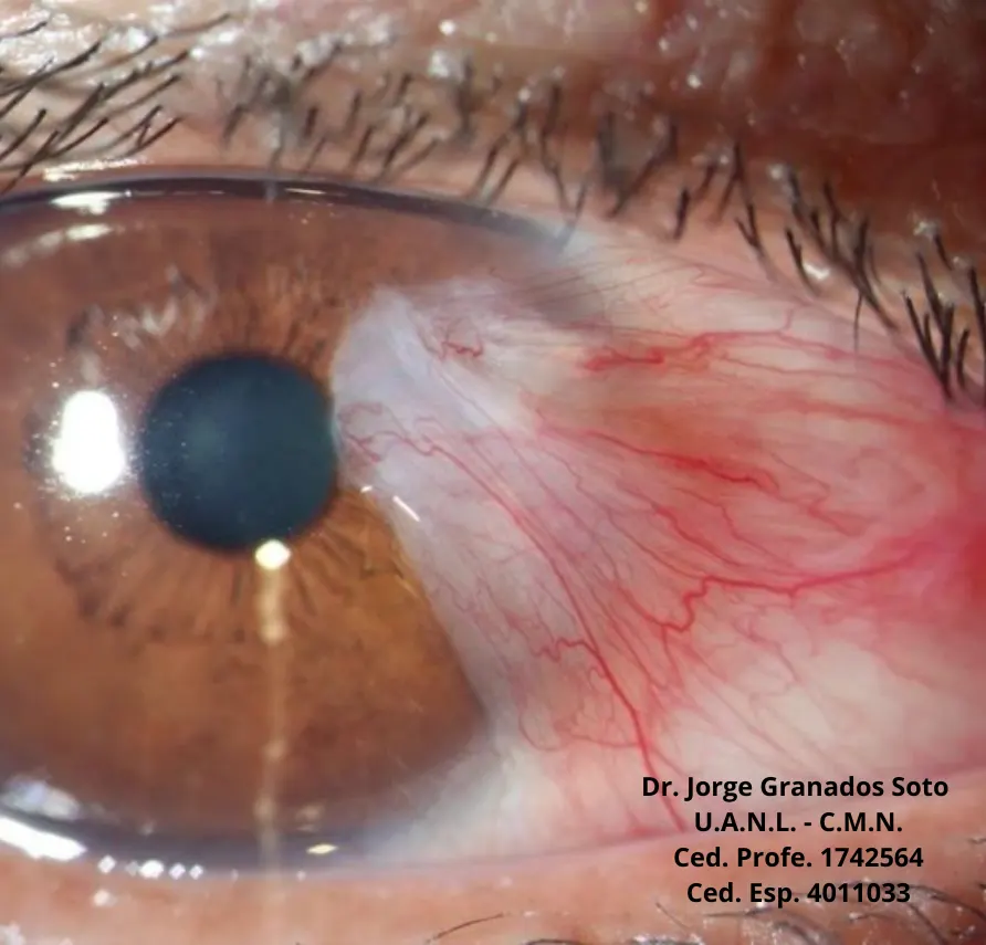 carnosidadeye (1)