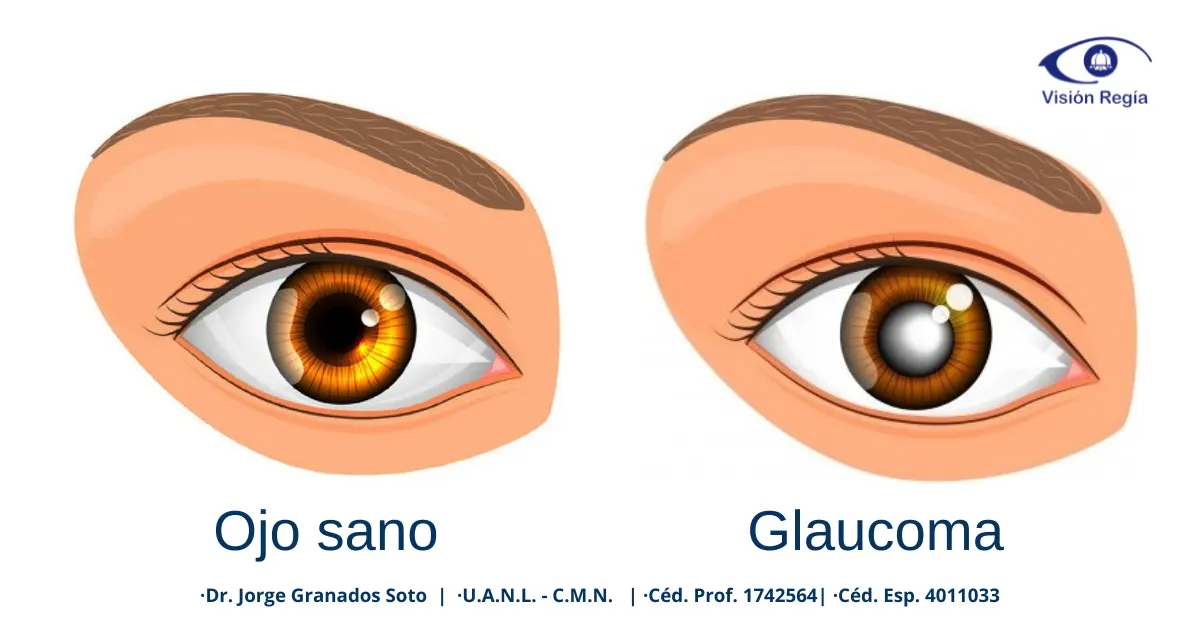 glaucomamty