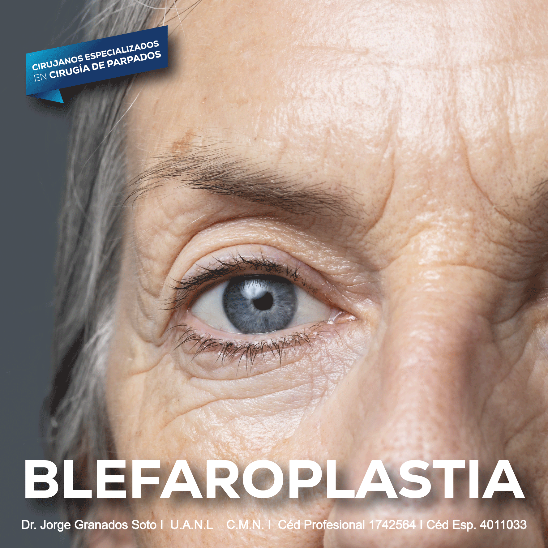 blefaroplastia-en-monterrey